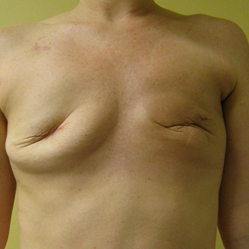 Latissimus Flap Reconstruction Before & After Gallery - Patient 154948771 - Image 1