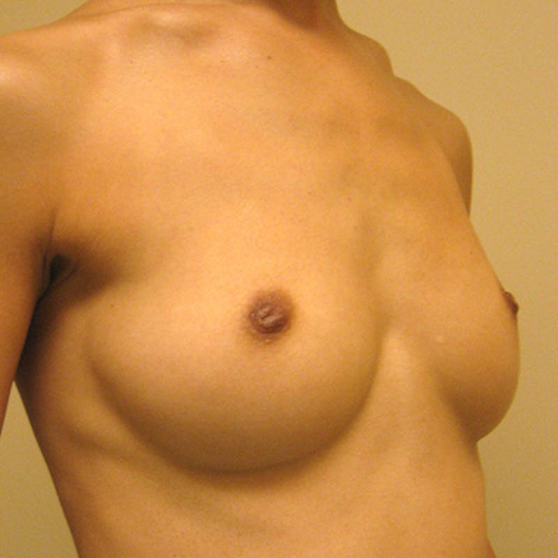 Silicone Breast Augmentation Before & After Gallery - Patient 154948765 - Image 3
