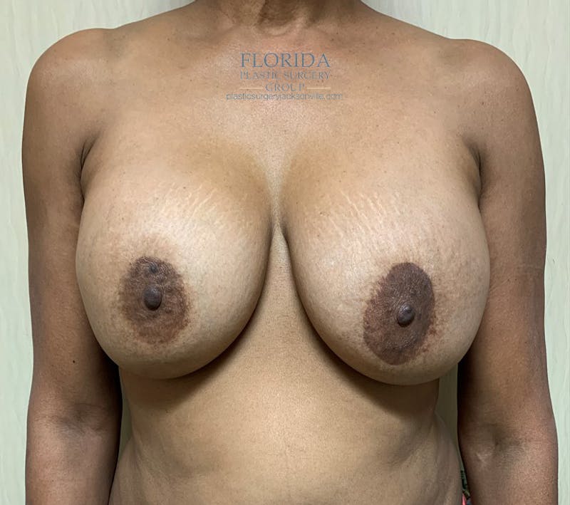 Breast Implant Removal Before & After Gallery - Patient 154948773 - Image 1