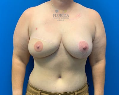 DIEP Flap Reconstruction Before & After Gallery - Patient 154948770 - Image 2