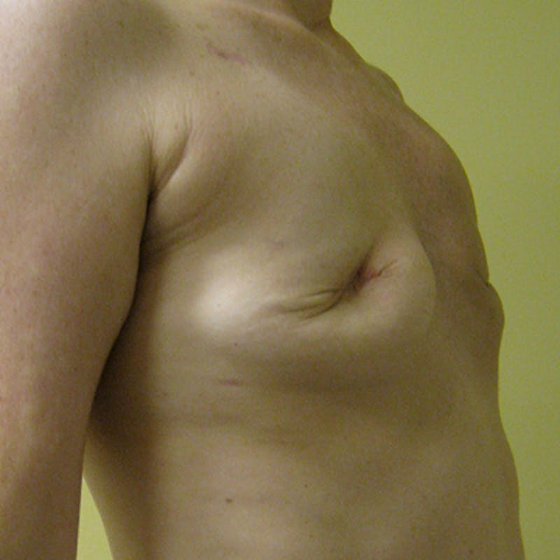 Latissimus Flap Reconstruction Before & After Gallery - Patient 154948771 - Image 3