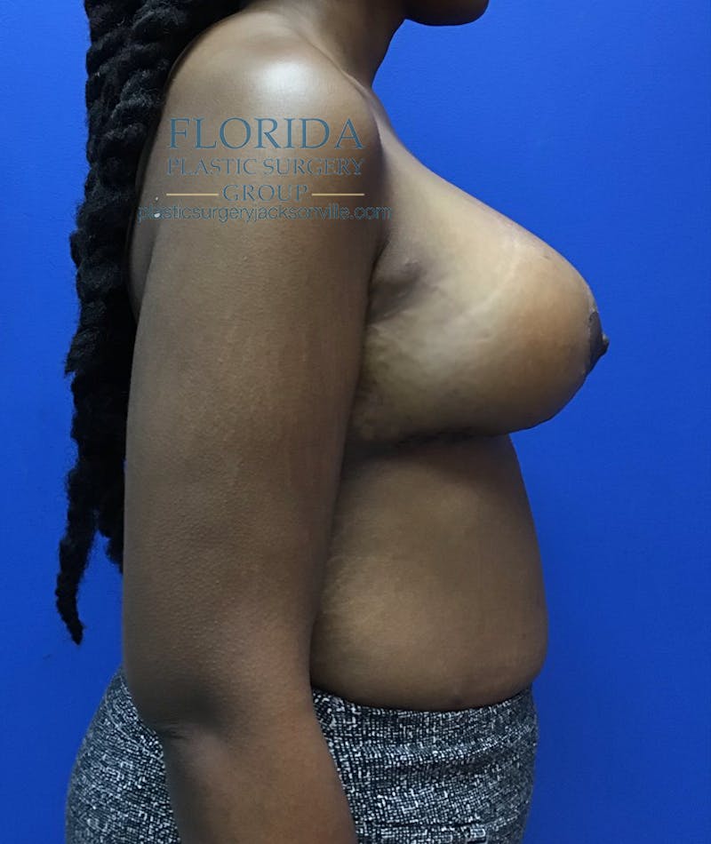 Breast Lift Before & After Gallery - Patient 154948769 - Image 4