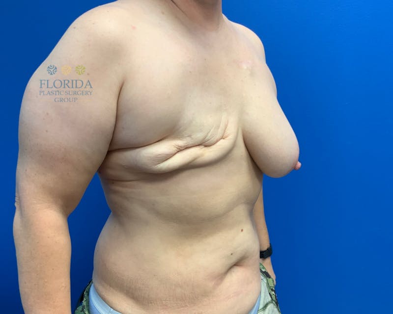 DIEP Flap Reconstruction Before & After Gallery - Patient 154948770 - Image 3