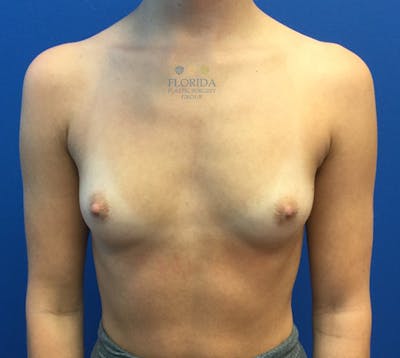 Silicone Breast Augmentation Before & After Gallery - Patient 154948779 - Image 1