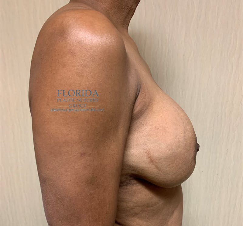 Breast Implant Removal Before & After Gallery - Patient 154948773 - Image 3