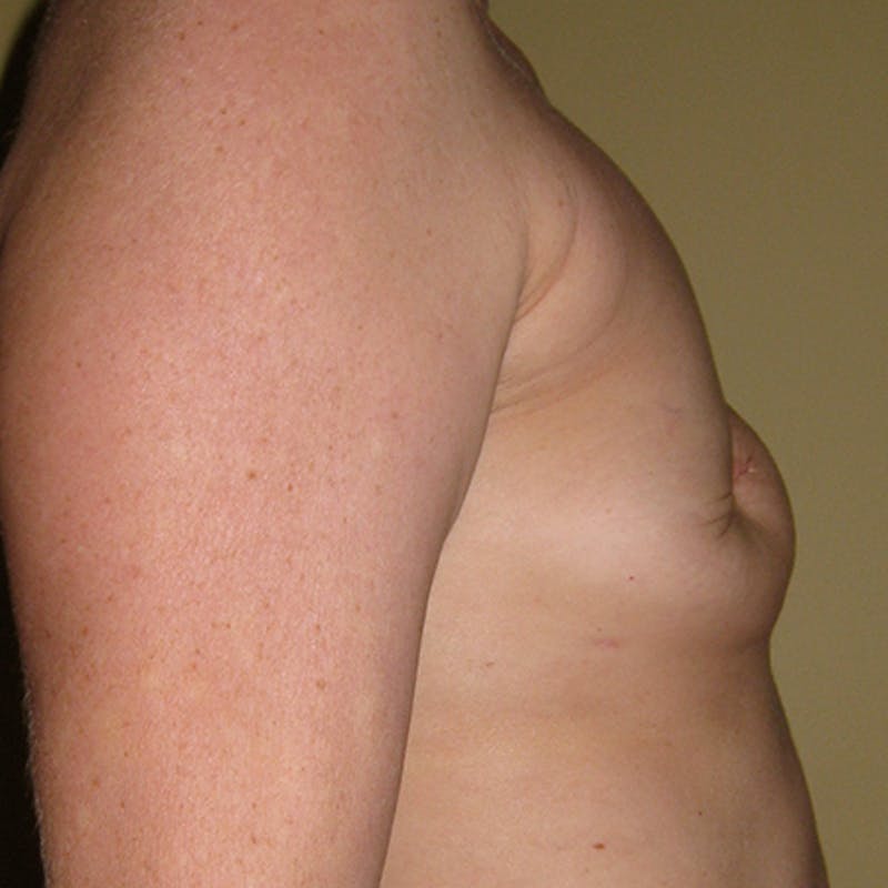 Latissimus Flap Reconstruction Before & After Gallery - Patient 154948771 - Image 5