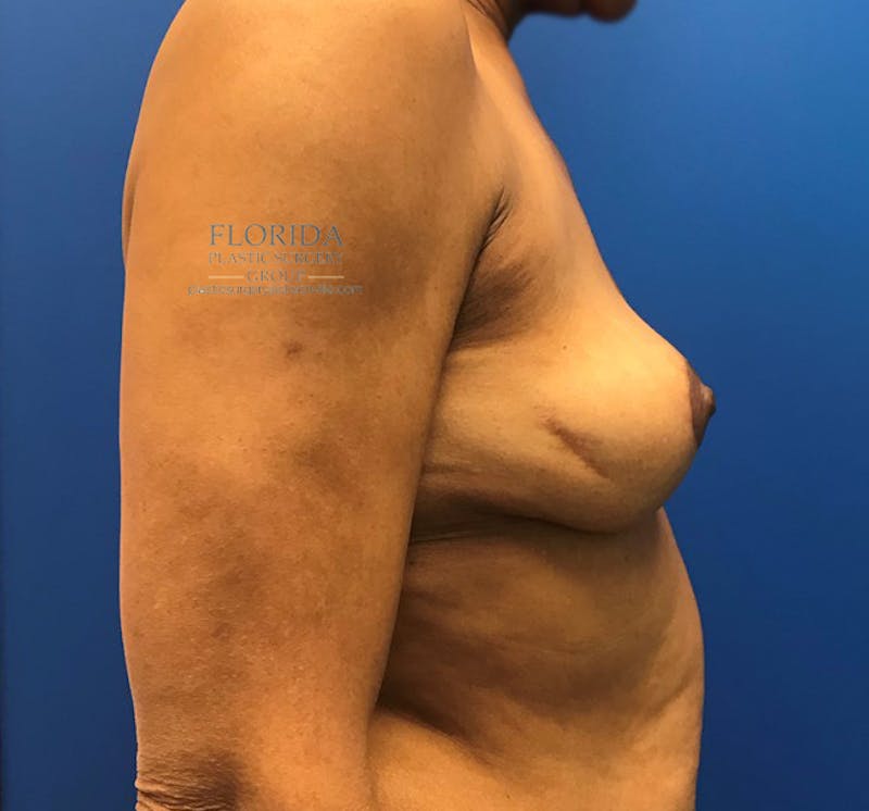 Breast Implant Removal Before & After Gallery - Patient 154948773 - Image 4
