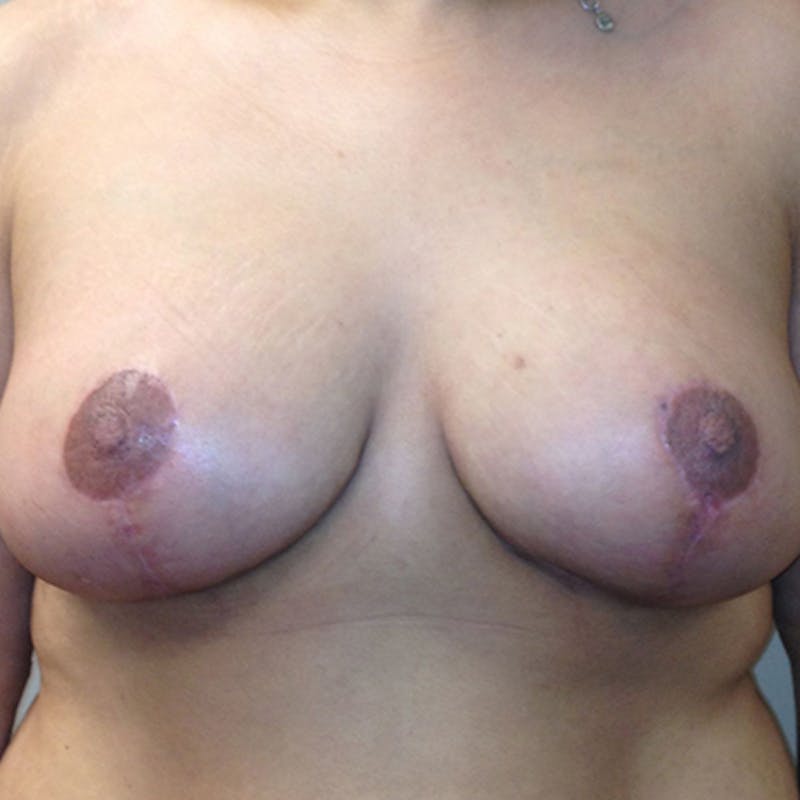 Breast Lift Before & After Gallery - Patient 154948776 - Image 2