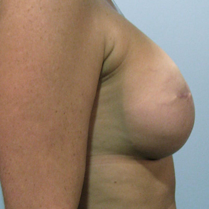 Latissimus Flap Reconstruction Before & After Gallery - Patient 154948771 - Image 6