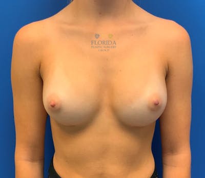 Silicone Breast Augmentation Before & After Gallery - Patient 154948779 - Image 2