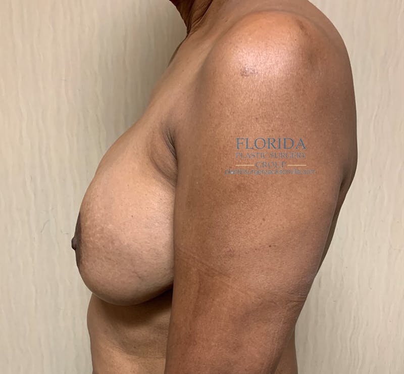 Breast Implant Removal Before & After Gallery - Patient 154948773 - Image 5