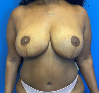 DIEP Flap Reconstruction Before & After Gallery - Patient 154948783 - Image 2