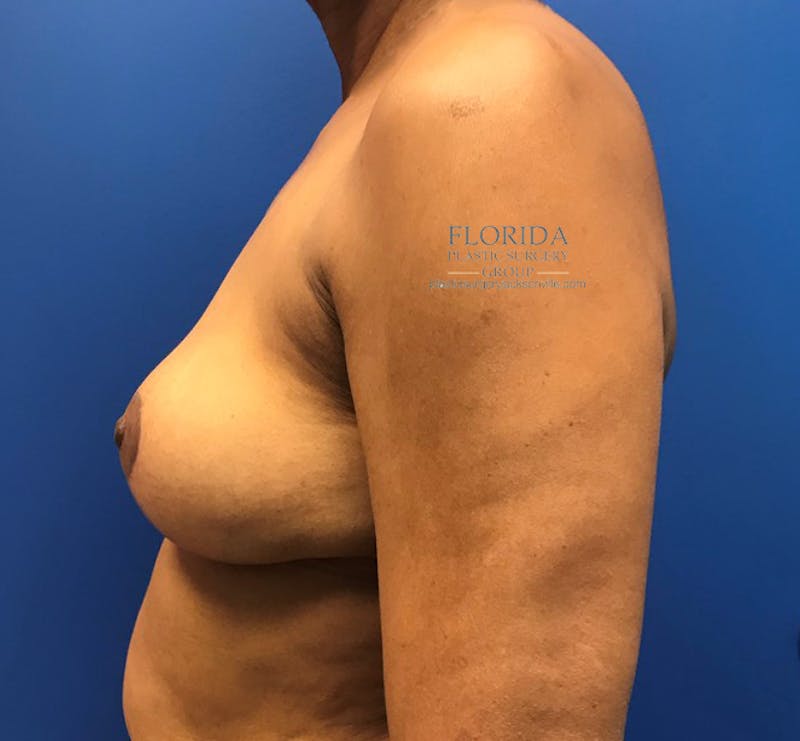 Breast Implant Removal Before & After Gallery - Patient 154948773 - Image 6