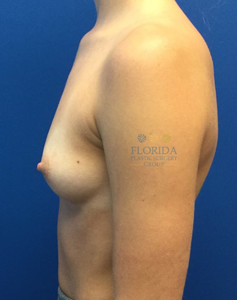 Silicone Breast Augmentation Before & After Gallery - Patient 154948779 - Image 3