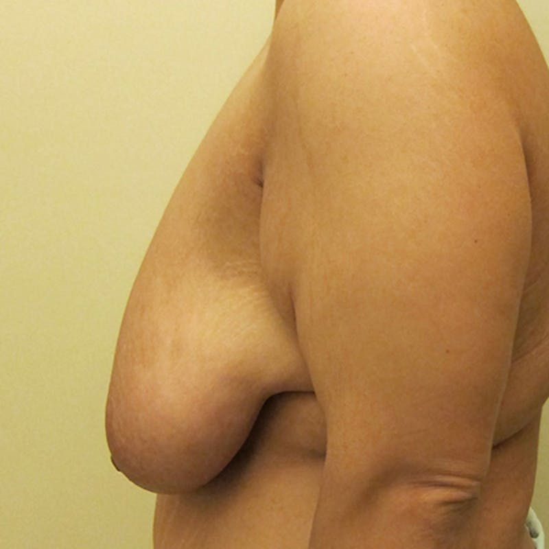 Breast Lift Before & After Gallery - Patient 154948776 - Image 5