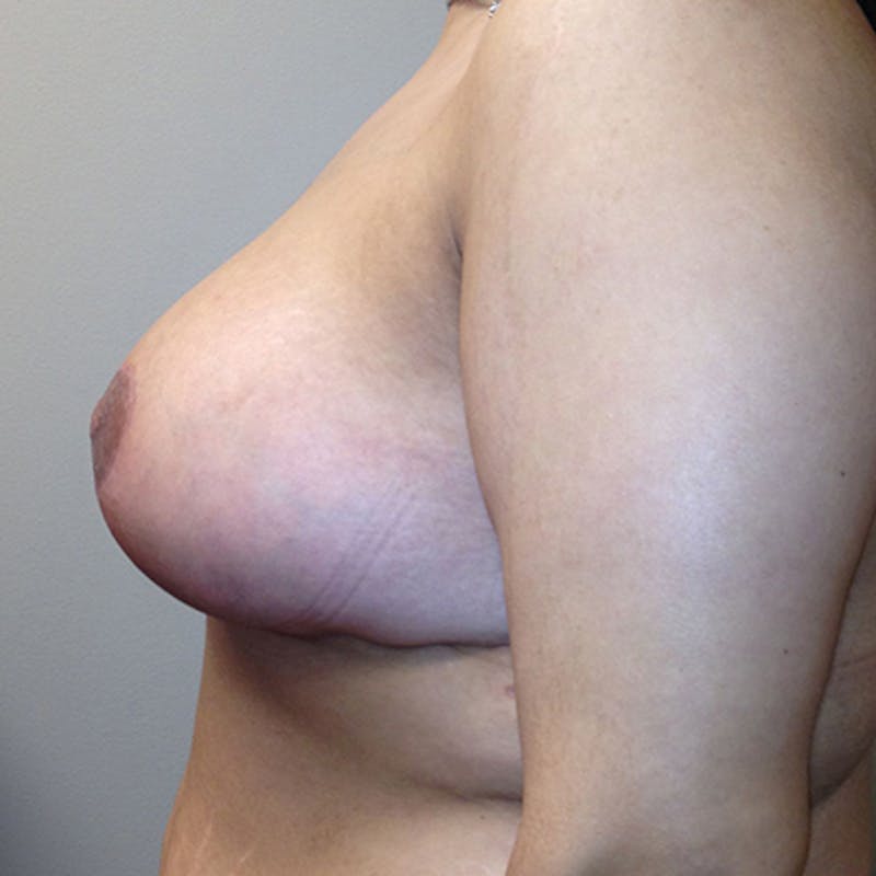 Breast Lift Before & After Gallery - Patient 154948776 - Image 6