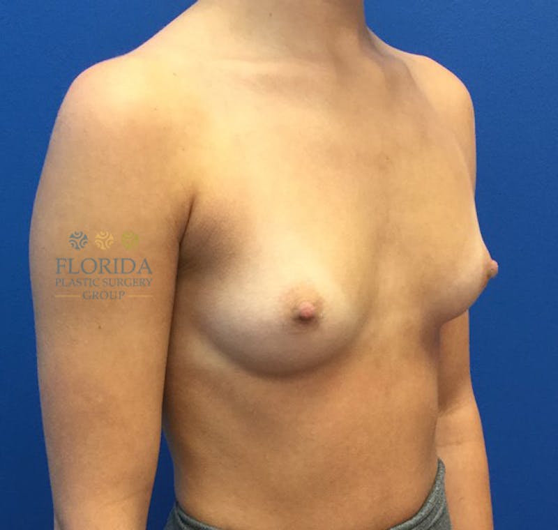 Silicone Breast Augmentation Before & After Gallery - Patient 154948779 - Image 5