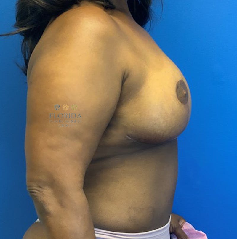 DIEP Flap Reconstruction Before & After Gallery - Patient 154948783 - Image 6