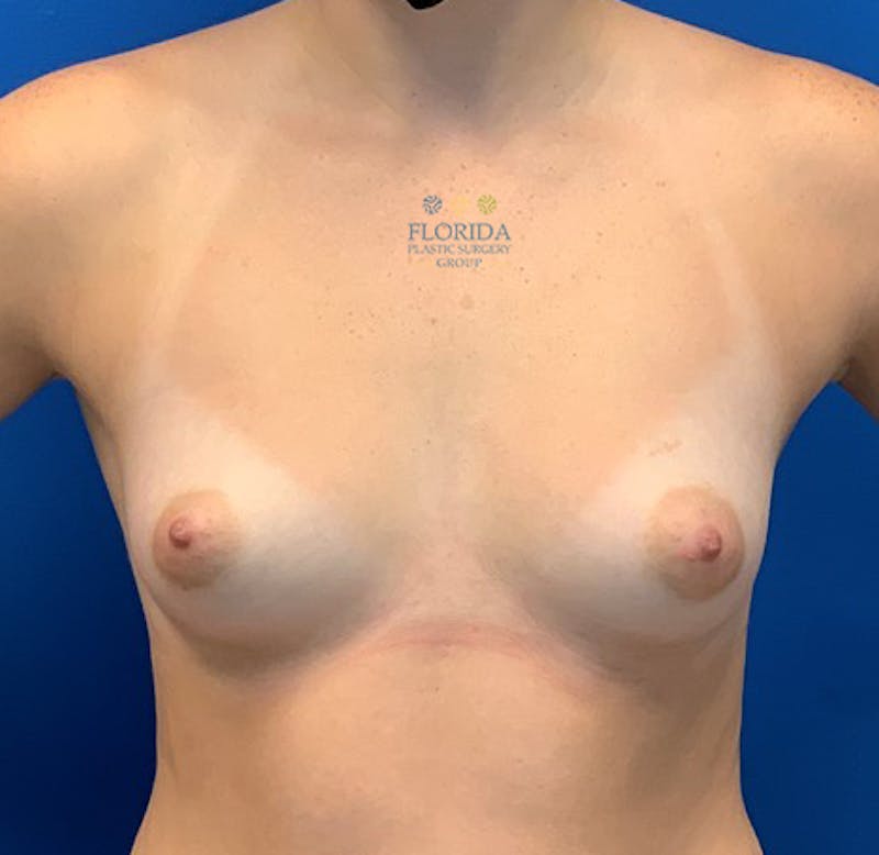 Silicone Breast Augmentation Before & After Gallery - Patient 154948793 - Image 1