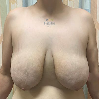 Breast Lift Before & After Gallery - Patient 154948786 - Image 1