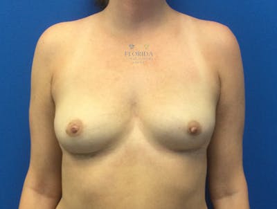 Breast Implant Removal Before & After Gallery - Patient 154948795 - Image 2