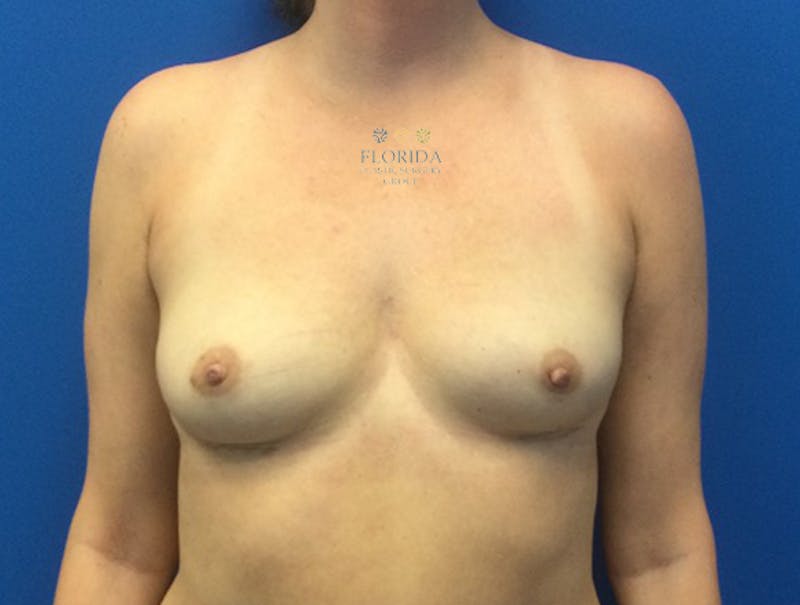 Breast Implant Removal Before & After Gallery - Patient 154948795 - Image 2