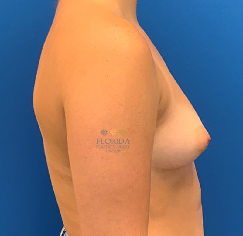 Silicone Breast Augmentation Before & After Gallery - Patient 154948793 - Image 3