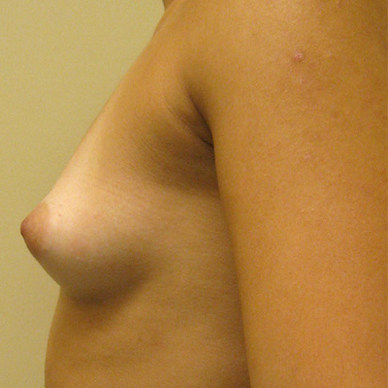 Saline Breast Augmentation Before & After Gallery - Patient 154948789 - Image 3