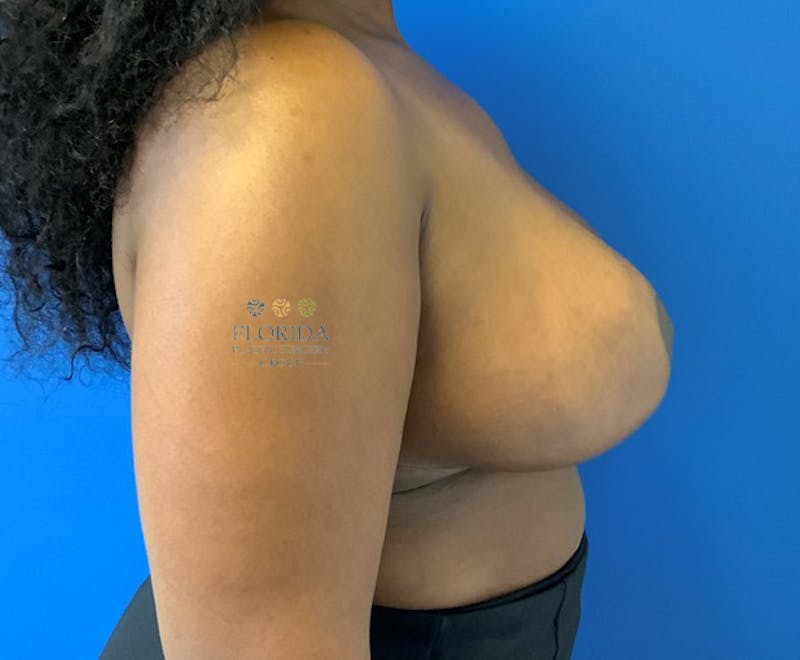 Breast Reduction Before & After Gallery - Patient 154948788 - Image 6