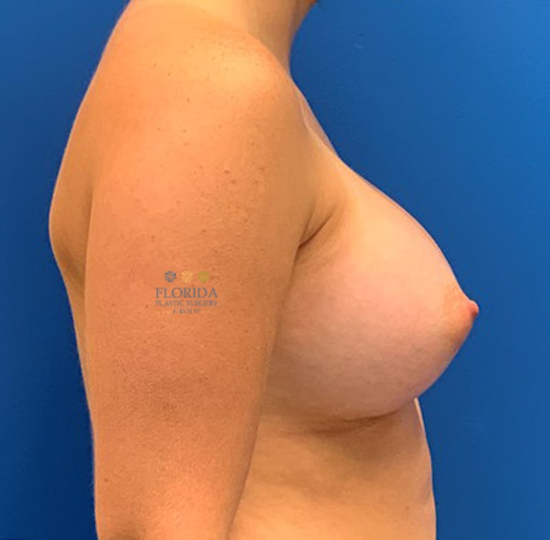 Silicone Breast Augmentation Before & After Gallery - Patient 154948793 - Image 4