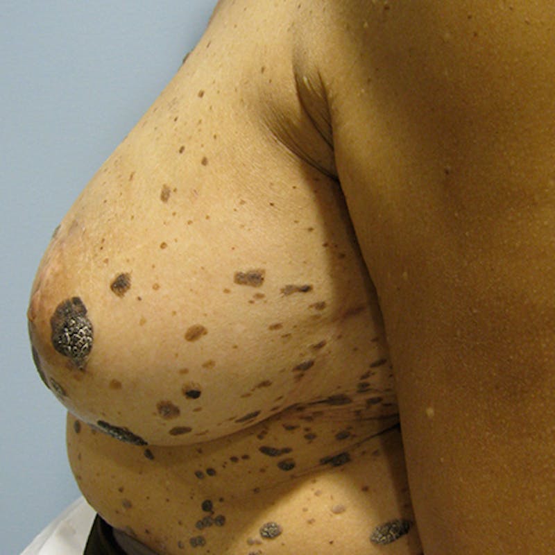 Latissimus Flap Reconstruction Before & After Gallery - Patient 154948790 - Image 5