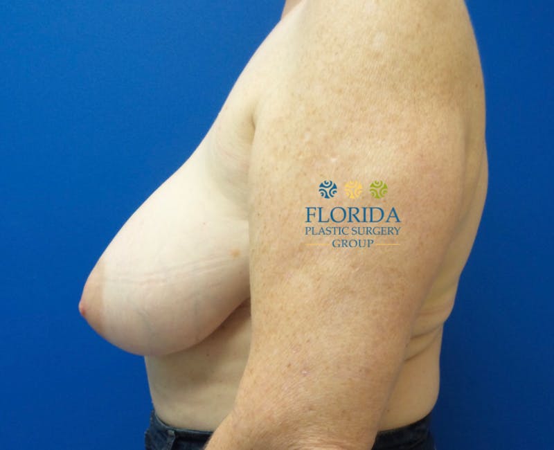 DIEP Flap Reconstruction Before & After Gallery - Patient 154948796 - Image 3