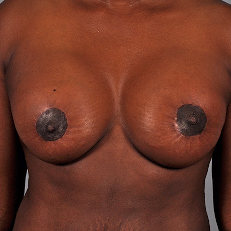 Augmentation Mastopexy Before & After Gallery - Patient 154948794 - Image 2