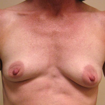 Saline Breast Augmentation Before & After Gallery - Patient 154948797 - Image 1