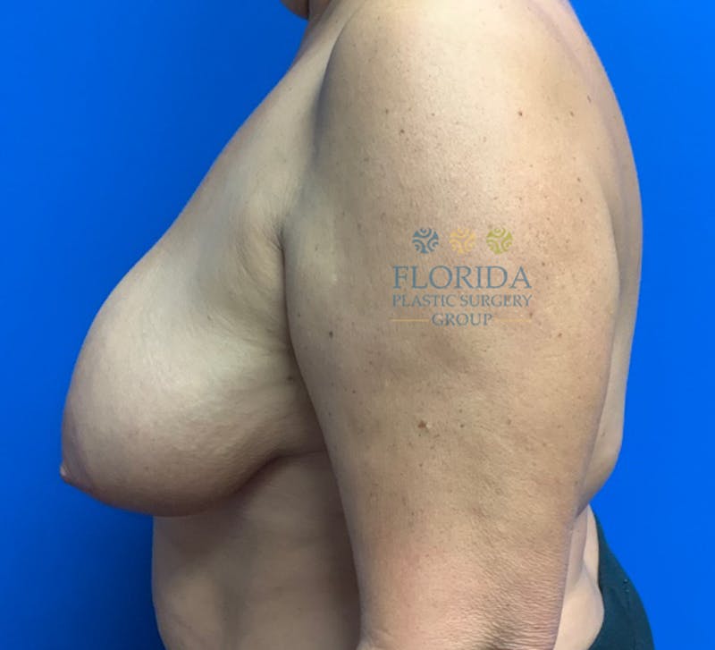 Breast Lift Before & After Gallery - Patient 154948799 - Image 3