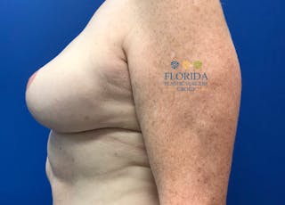 DIEP Flap Reconstruction Before & After Gallery - Patient 154948796 - Image 4