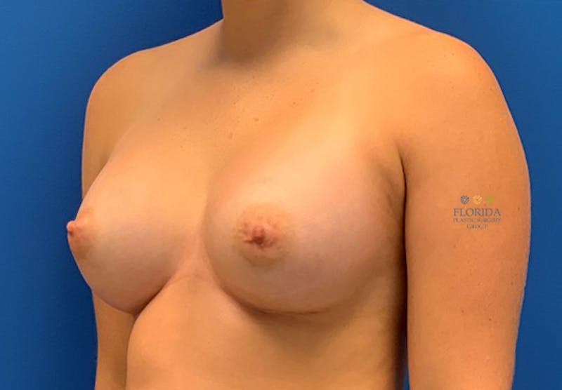 Silicone Breast Augmentation Before & After Gallery - Patient 154948793 - Image 6
