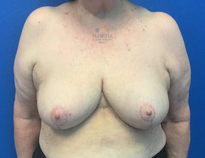 Breast Reduction Before & After Gallery - Patient 154948798 - Image 2