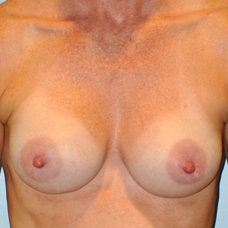 Saline Breast Augmentation Before & After Gallery - Patient 154948797 - Image 2