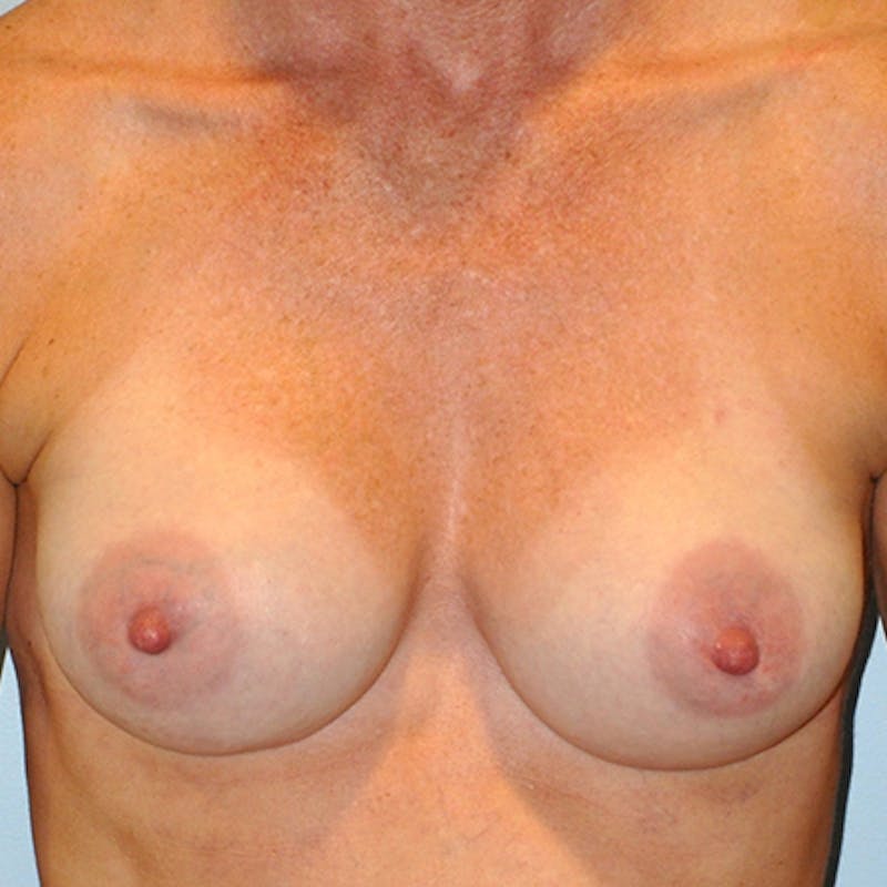 Saline Breast Augmentation Before & After Gallery - Patient 154948797 - Image 2