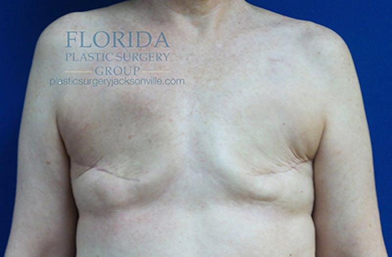 Latissimus Flap Reconstruction Before & After Gallery - Patient 154948812 - Image 1