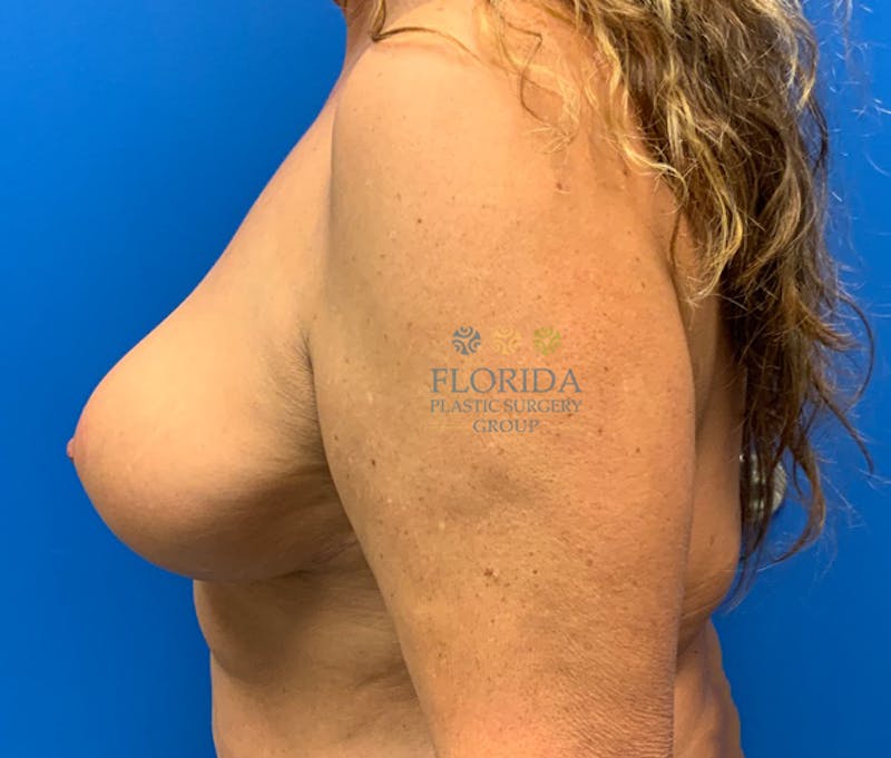 Breast Lift Before & After Gallery - Patient 154948799 - Image 4
