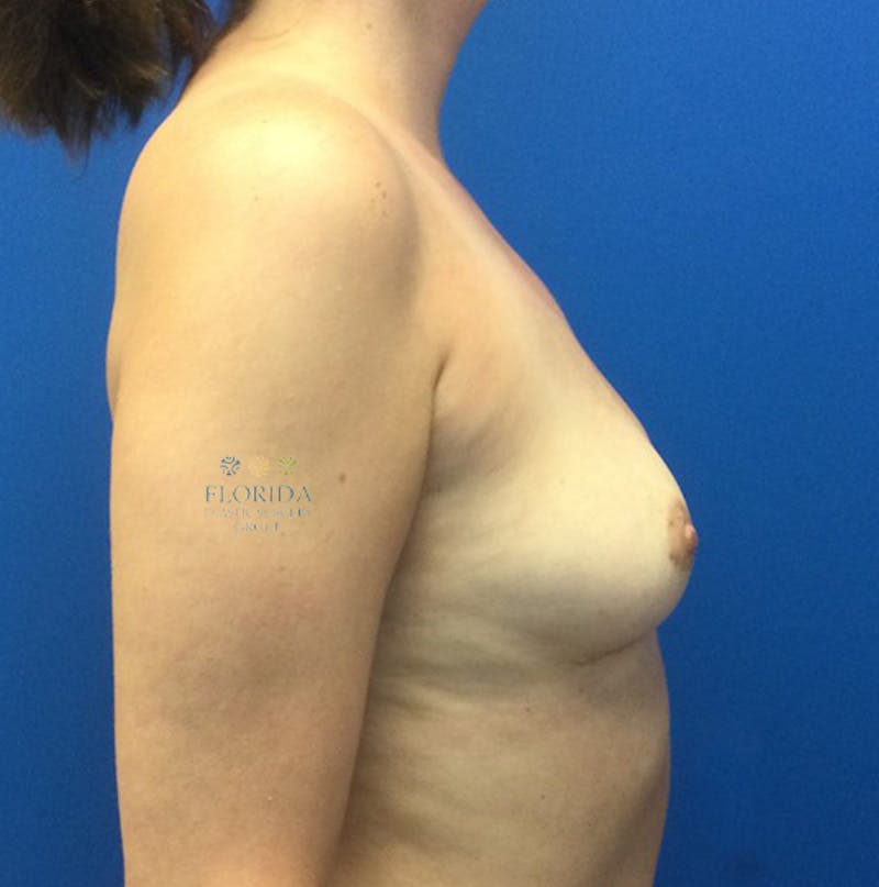 Breast Implant Removal Before & After Gallery - Patient 154948795 - Image 6