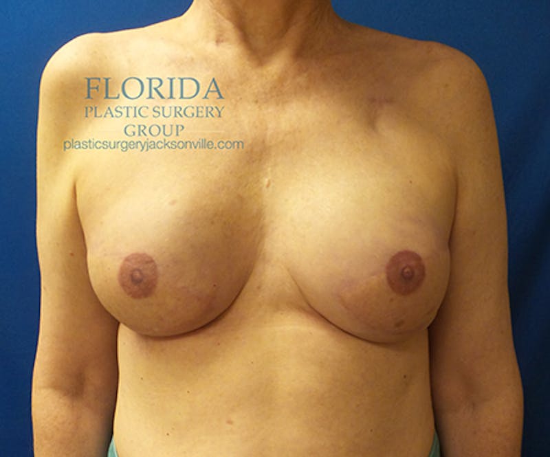 Latissimus Flap Reconstruction Before & After Gallery - Patient 154948812 - Image 2
