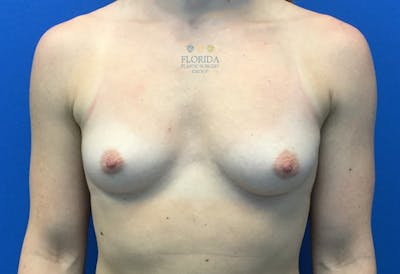 Silicone Breast Augmentation Before & After Gallery - Patient 154948803 - Image 1