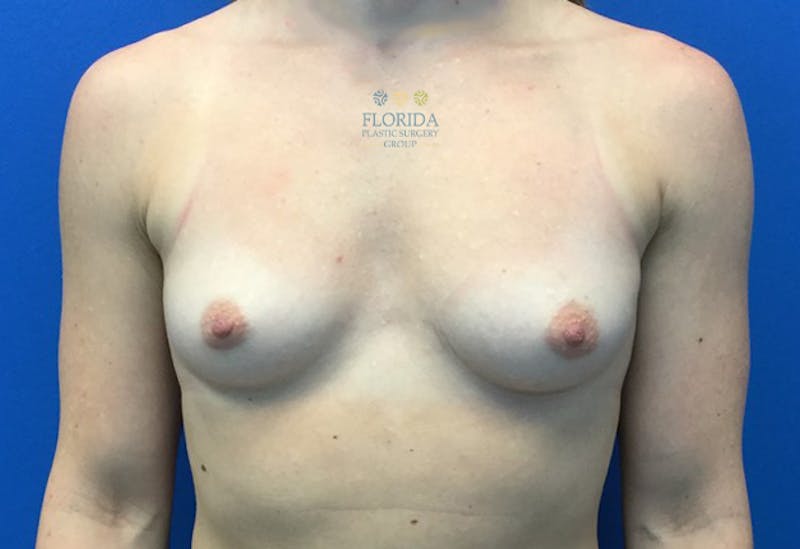 Silicone Breast Augmentation Before & After Gallery - Patient 154948803 - Image 1