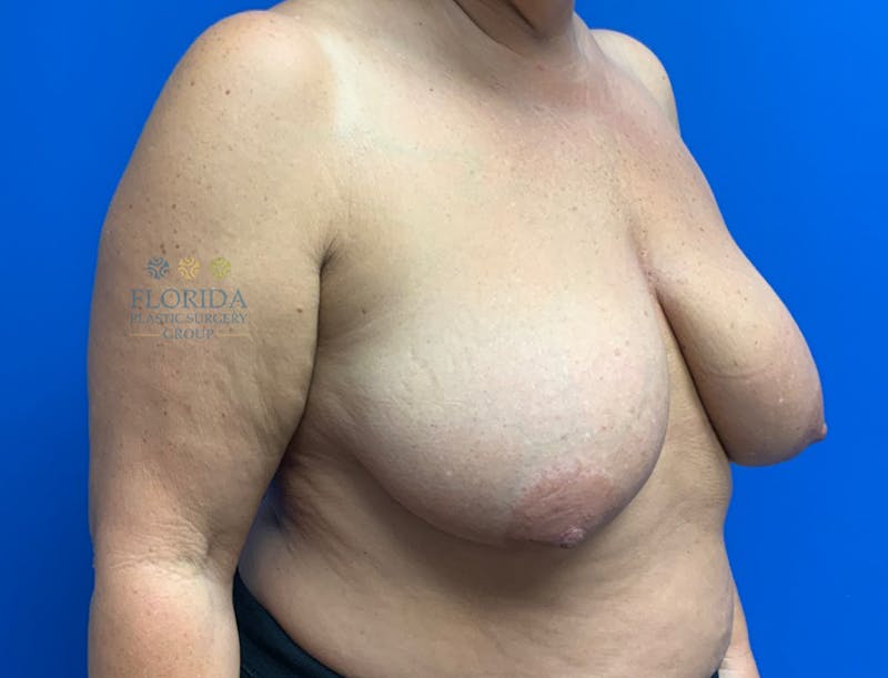 Breast Lift Before & After Gallery - Patient 154948799 - Image 5