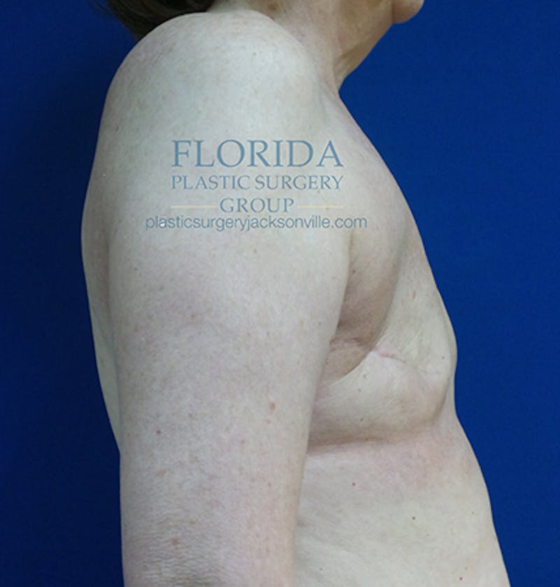 Latissimus Flap Reconstruction Before & After Gallery - Patient 154948812 - Image 3