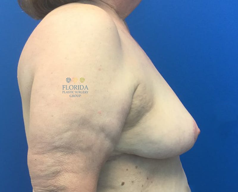 Breast Reduction Before & After Gallery - Patient 154948798 - Image 4
