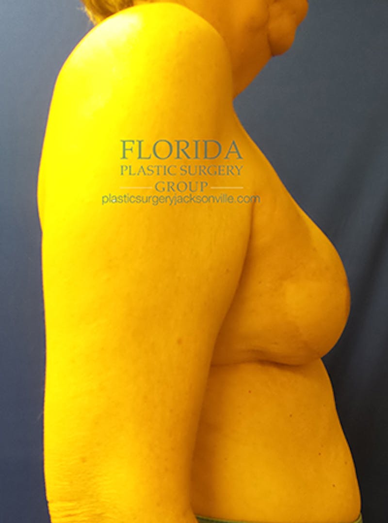 Latissimus Flap Reconstruction Before & After Gallery - Patient 154948812 - Image 4